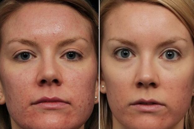 Laser Rejuvenatioun