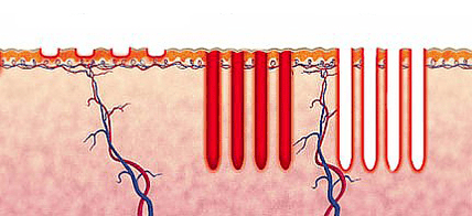 Wéi funktionnéiert Fractional Laser