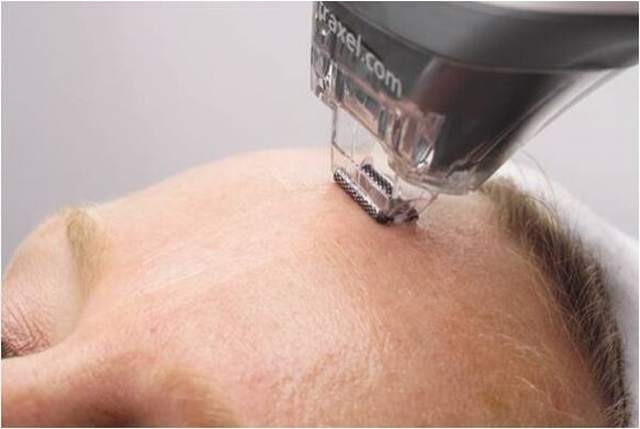 Peeling Prozedur fir Gesiicht Haut Verjüngung